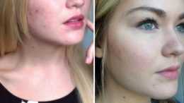 Salisilik Asit ile Sivilce Tedavisi