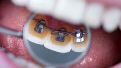 Ortodontide Sık Sorulanlar